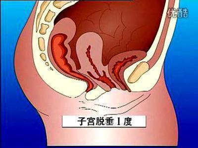 子宫切除有四五年,身体每况愈下,一天比一天差.