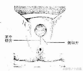 10个顺产9个需要"会阴侧切",你准备好了吗?