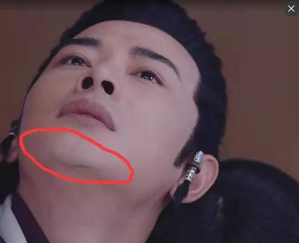 罗晋下巴怎么了?难道也植入假体了?