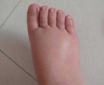 孕妇脚肿是什么原因引起的 孕妇如何缓解脚肿