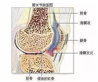 滑膜炎——自然医学调理方案!