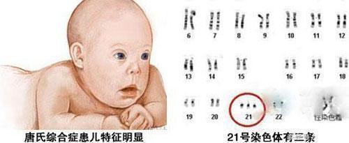 生出唐氏宝宝的原因 1,遗传 10%唐氏综合征是因为来自父亲的额外