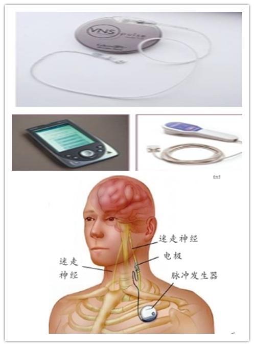 迷走神经刺激器植入的围手术期护理