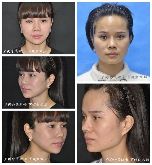 卢丙仑教授:v脸成型记—改脸型手术展示