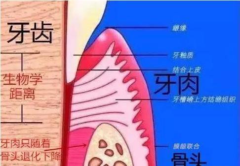 牙龈萎缩真的是不治之症?