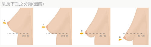 大腿于婕,因造成v大腿萎缩胸部过度上班族怎么样瘦女星图片