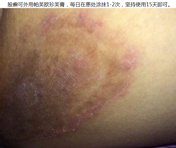 股癣严重吗,知己知彼治愈快?