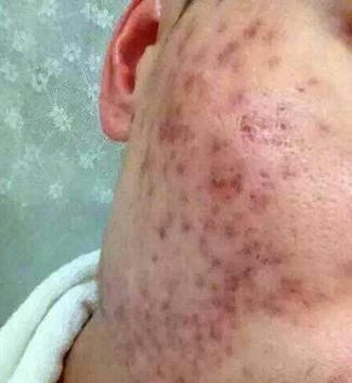 你了解囊肿型痤疮(痘痘)吗-资格考试-电气工程师考试网