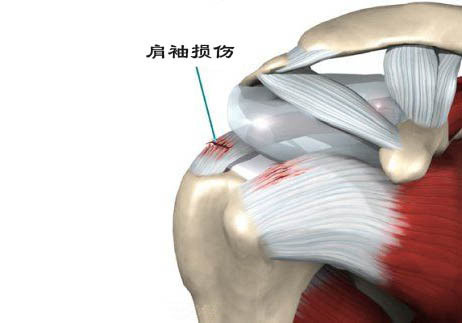 肩部疼痛无力或是肩袖损伤