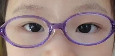 孩子双眼度数有差异,怎么避免发展成斜弱视?