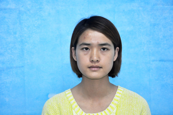 卢丙仑教授:V脸首选下颌角手术技术