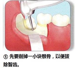 拔智齿后几天才能好，需要注意些什么