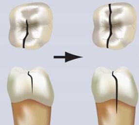 牙齿隐裂能自愈吗