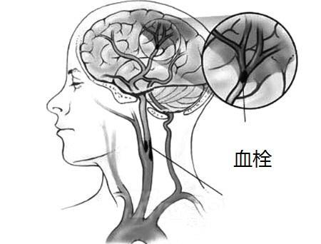 中风病人口吐黑褐色物