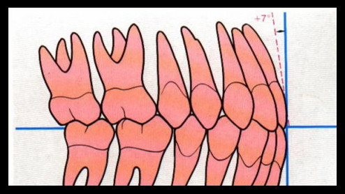 正常的牙齿排列是这个样子，看看你的是否正常?
