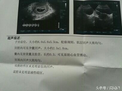 孕妇妈妈为什么做了b超还要做四维彩超呢?