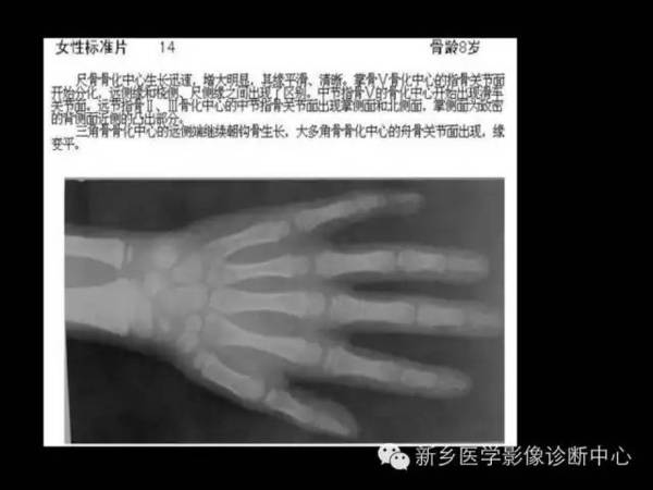 怎么看骨龄有没有闭合 a5wdtg81151274898205.jpeg