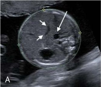 回顾分析发现,部分右肝内门静脉超声未见血流信号及 mri 见少许流空