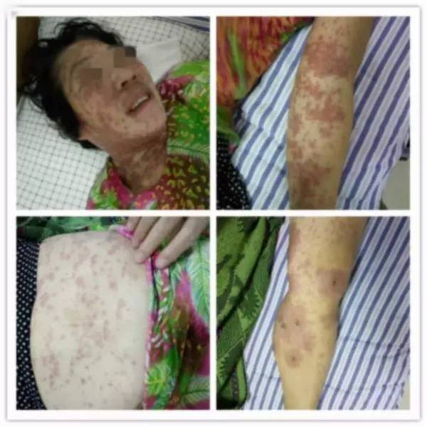 女子服用了这种药,全身上下都是红点点