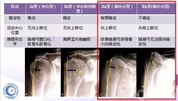 喙肩弓是否完整 ·年龄 ·运动水平 肩袖撕裂关节病的分型 (see