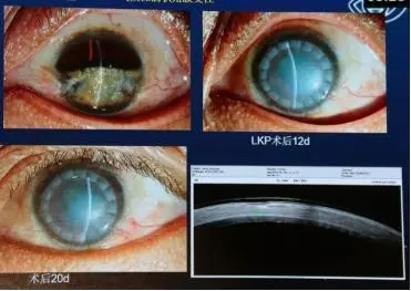 图9. 气候性滴状角膜变性病例手术前后的情况