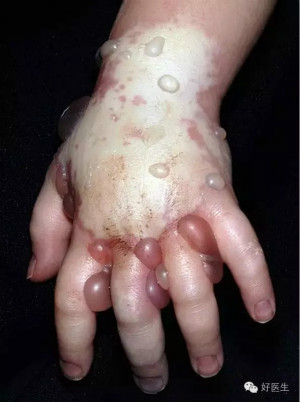 应激性溃疡并发症 触目惊心:静滴药物外渗竟造