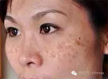 孕期长斑是什么原因?