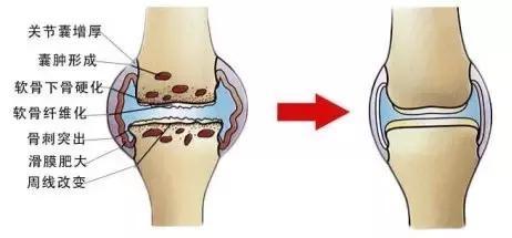 指关节肿胀疼痛 人体关节肿胀但无痛是什么原