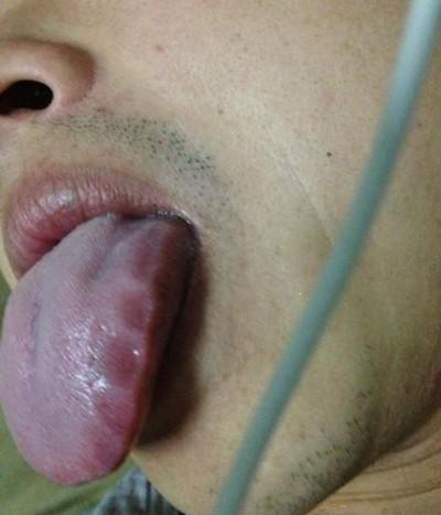 湿气重与舌边有齿痕(齿印),身体肥胖水肿有密切关系,当人体脾虚,运化