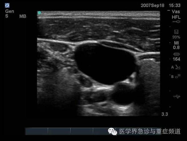 二维超声模式下,短轴切面可见颈内静脉位置更表浅,探头加压管壁