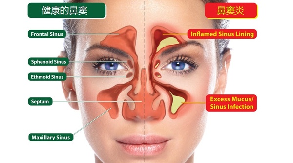 不同颜色的鼻涕说明了什么健康问题?