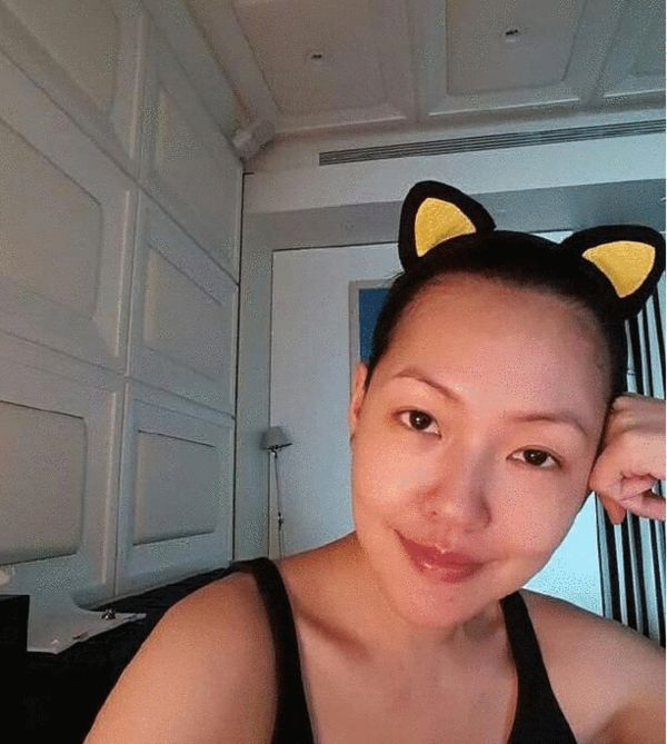 小S治好了鼻中隔弯曲 再也不担心用嘴巴呼吸了