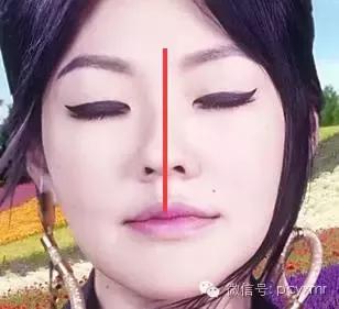 什么是"鼻中隔弯曲"? 鼻中隔偏曲系由于鼻中隔在发育过程中