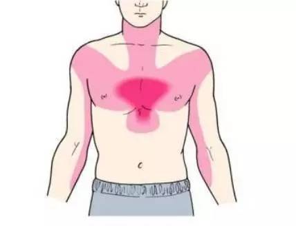 典型的心绞痛发作时位于胸骨中上部,但如果认定心绞痛只会发生在心脏