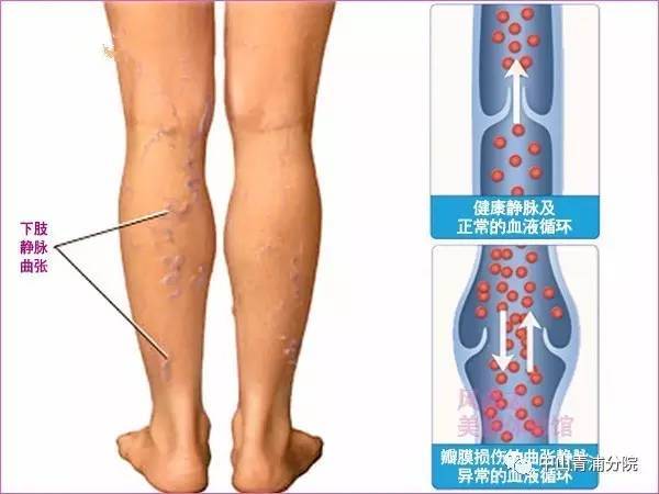 医疗技术特色 中山医院青浦分院血管外科主要以治疗下肢静脉性疾病为