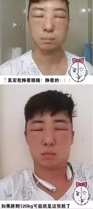 反而更加严重,脸部明显红肿,眼睛也肿得眯成一条缝