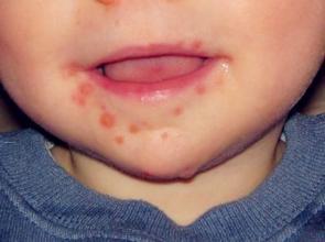 微信疯狂猜成语病安瘦然疹_湿疹和热疹的区别图片(2)