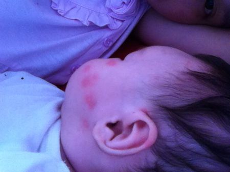 什么是特应性湿疹 a9nelv713164573728.jpg