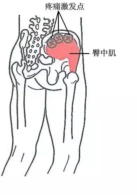 【临床上】常见软组织损伤压痛点