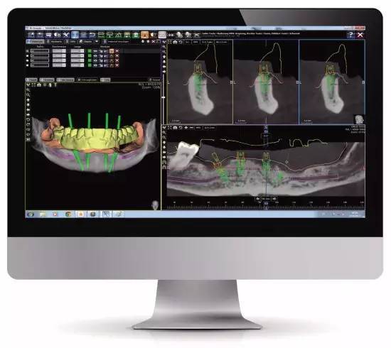 cbct扫描--》导入数据重建三维图像--》种植修复设计--》制造种植导板
