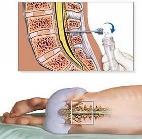 腰椎穿刺术操作流程