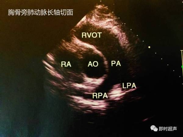 二 胸骨旁主动脉根部短轴切面 三 胸骨旁肺动脉长轴切面 四 二尖瓣口