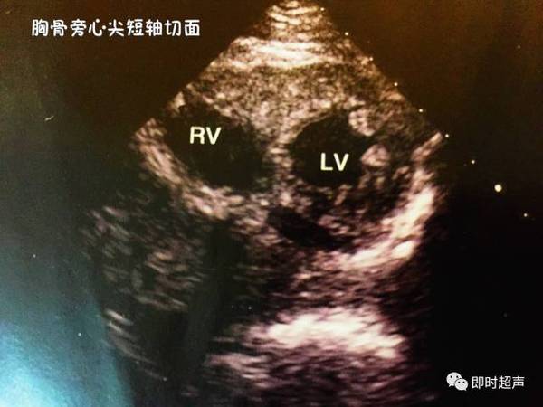 主要观察:左心室近心尖的病变,如心尖室壁瘤,血栓等.