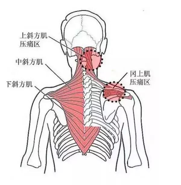 肩胛提肌压痛点