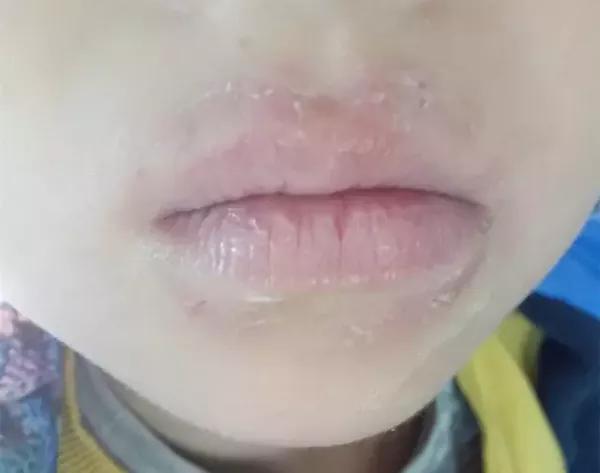 当心!儿童舔出来的皮肤病