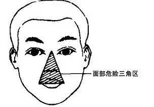 危险三角区长痘痘弄破应当怎么处理?