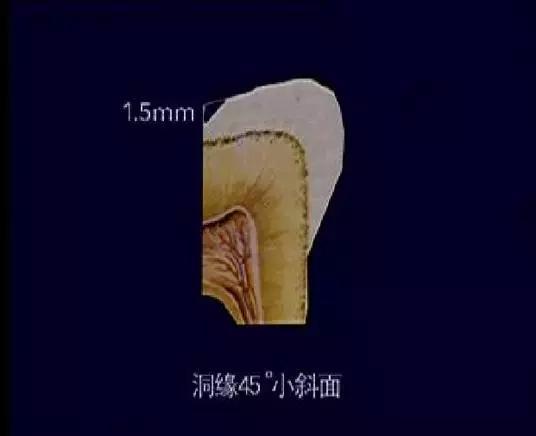 预备洞缘斜面. ①洞斜面要求 一般在洞缘预备出45°斜面 斜面宽度约1.