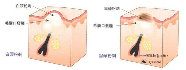 痘痘 1.皮肤属于油性皮肤,皮脂腺过于发达,皮脂分泌过旺.