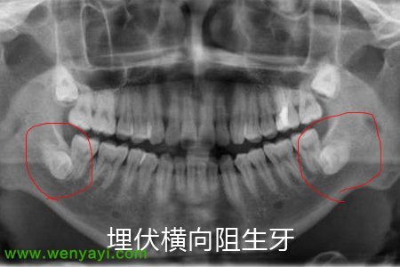 从门牙开始数第八颗牙.