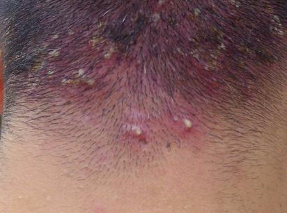 【痘痘】痤疮和毛囊炎的区别